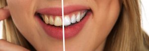 Blanqueamiento dental en Barcelona